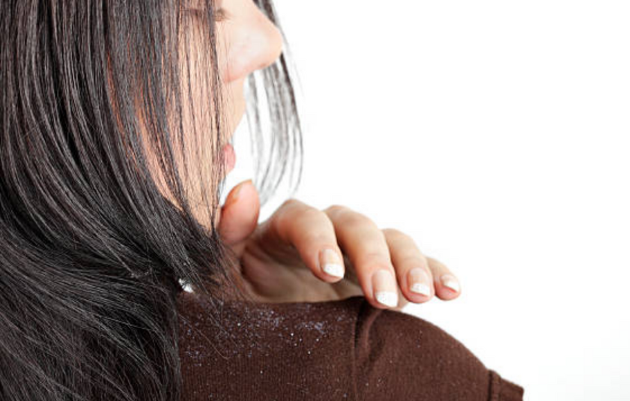 Causes of Dandruff And How To Choose The Best Dandruff Shampoo